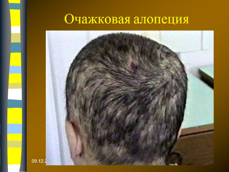 09.12.2017 Очажковая алопеция